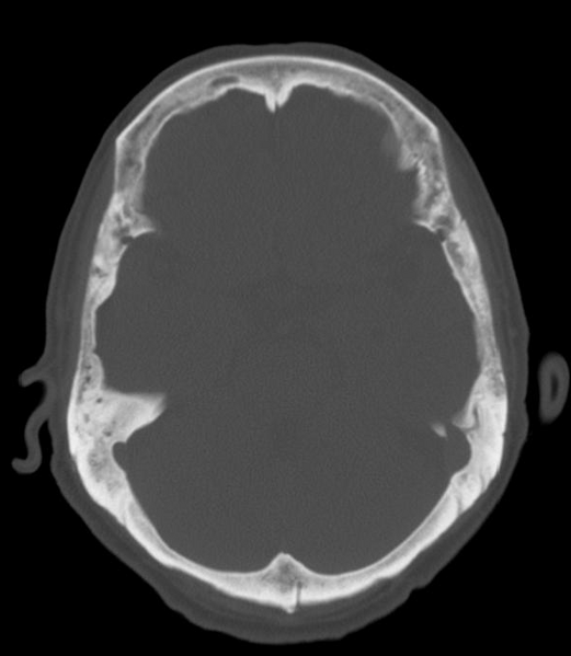 File:Anomalous intracranial venous drainage (Radiopaedia 28161-28418 Axial 8).png