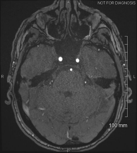 File:Anterior cerebral artery aneurysm (Radiopaedia 80683-94127 Axial MRA 68).jpg