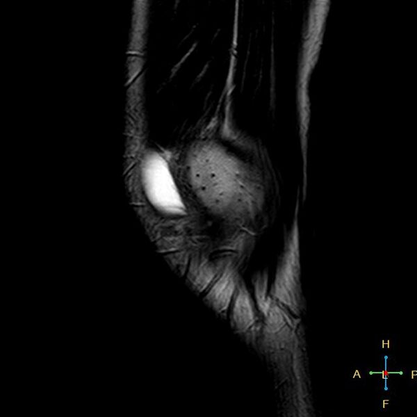 File:Anterior cruciate ligament tear - complete (Radiopaedia 24907-25170 Sagittal T2 18).jpg
