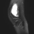 Anterior cruciate ligament tear - pediatric (Radiopaedia 62152-70260 Sagittal PD fat sat 32).jpg