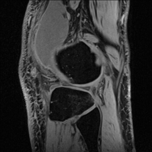File:Anterior cruciate ligament tear - ramp lesion (Radiopaedia 71883-82322 Sagittal T1 vibe 30).jpg