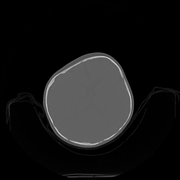 File:Anterior plagiocephaly (Radiopaedia 71836-82273 C 45).jpg