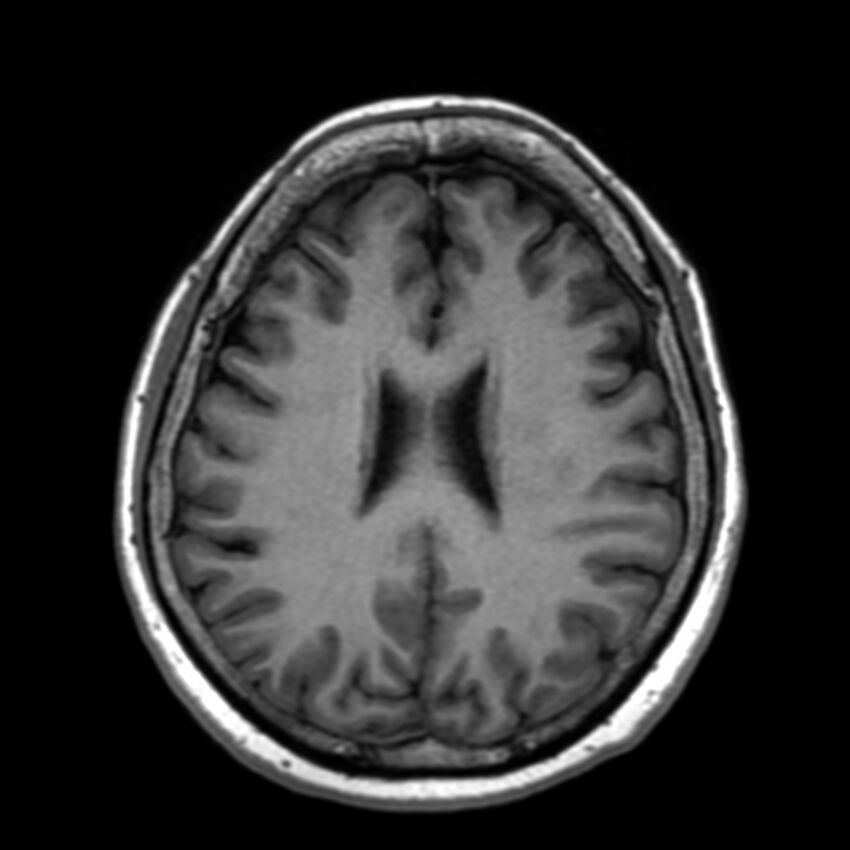 Anti-MOG encephalomyelitis (Radiopaedia 73831-84646 Axial T1 33).jpg