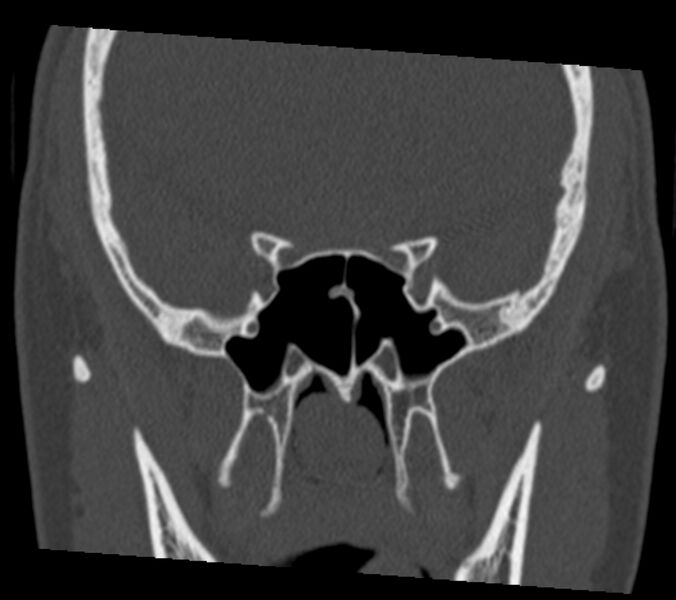 File:Antrochoanal polyp (Radiopaedia 21894-21868 Coronal bone window 25).jpg