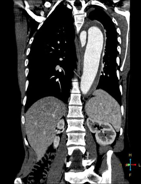 File:Aortic aneurysm and penetrating ulcer (Radiopaedia 23590-23704 B 17).jpg