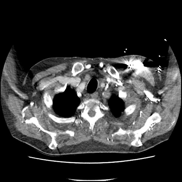 File:Aortic arch graft infection (FDG PET-CT) (Radiopaedia 71975-82437 A 4).jpg