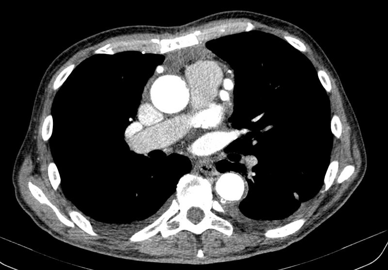 File:Aortic arch saccular aneurysm (Radiopaedia 19430-19457 B 22).jpg