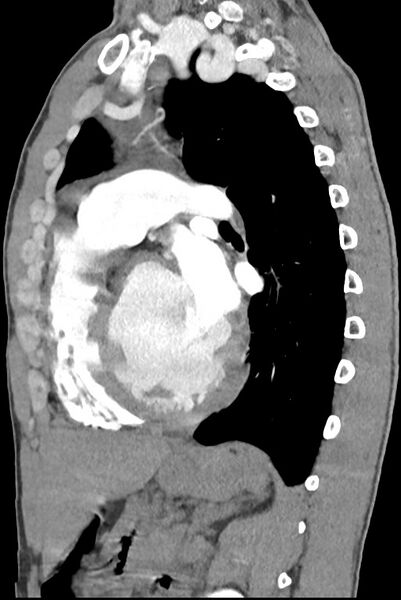 File:Aortic coarctation with aneurysm (Radiopaedia 74818-85828 B 100).jpg