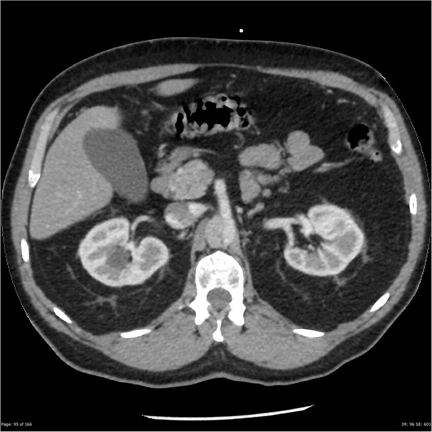 Aortic dissection- Stanford A (Radiopaedia 37759-39664 A 86).jpg