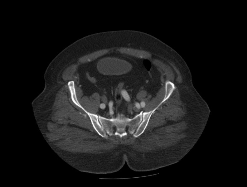 File:Aortic dissection (Radiopaedia 28802-29105 A 88).jpg