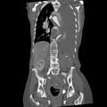 Aortic dissection (Radiopaedia 68763-78691 B 26).jpeg