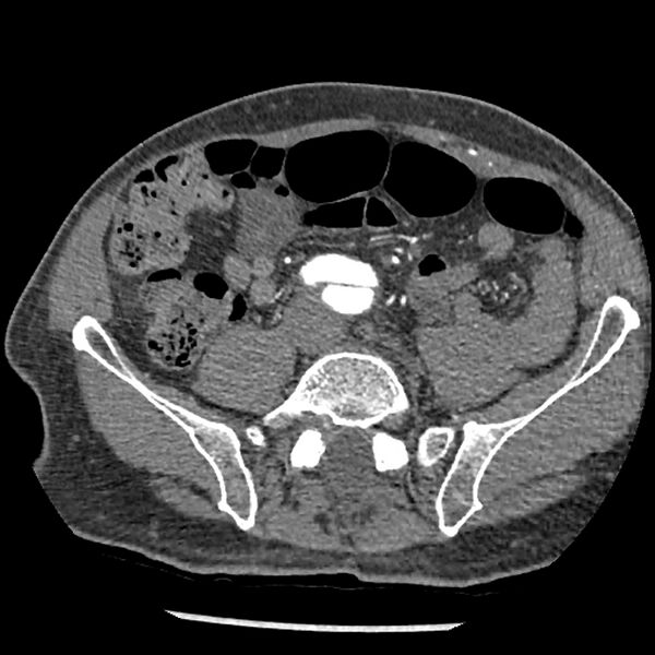 File:Aortic dissection - DeBakey Type I-Stanford A (Radiopaedia 79863-93115 A 65).jpg