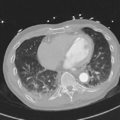 Aortic dissection - DeBakey type II (Radiopaedia 64302-73082 Axial lung window 43).png