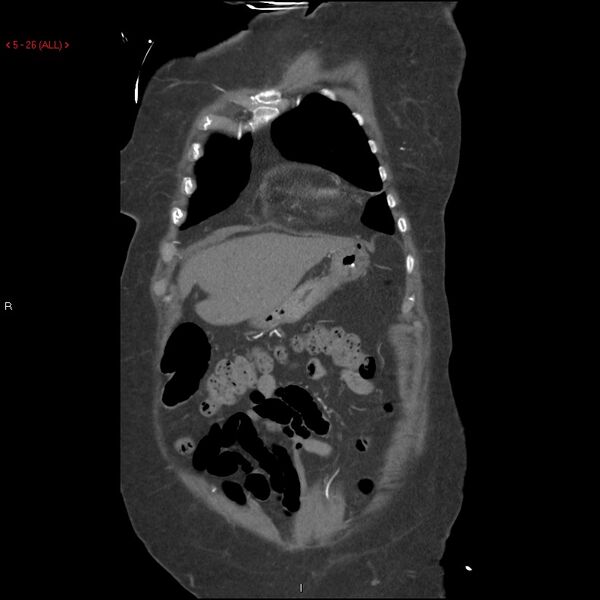 File:Aortic intramural hematoma (Radiopaedia 27746-28001 B 3).jpg