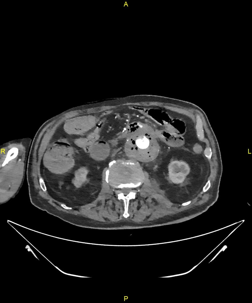 Aortoenteric fistula (Radiopaedia 84308-99603 B 158).jpg