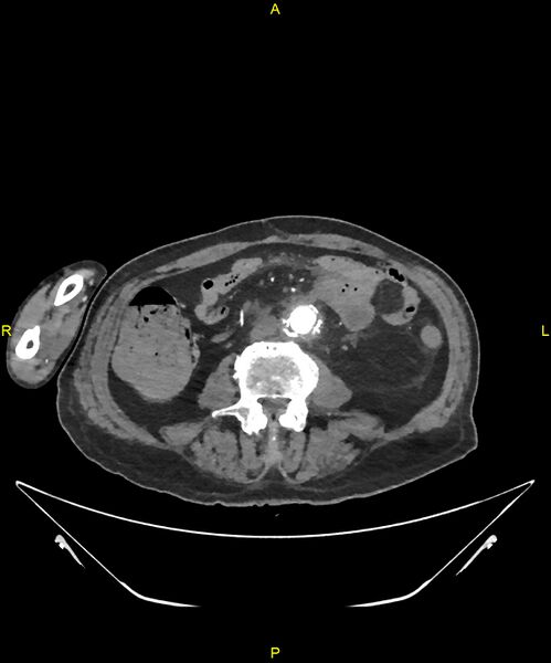 File:Aortoenteric fistula (Radiopaedia 84308-99603 B 209).jpg