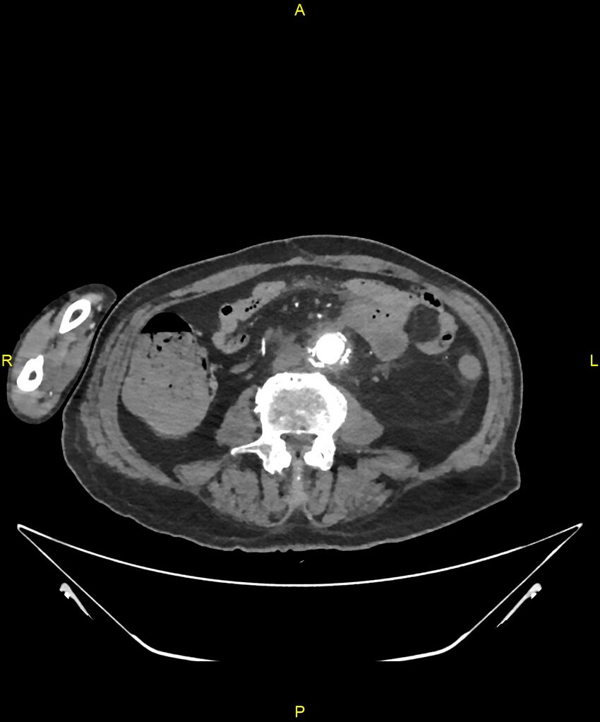 Aortoenteric fistula (Radiopaedia 84308-99603 B 209).jpg