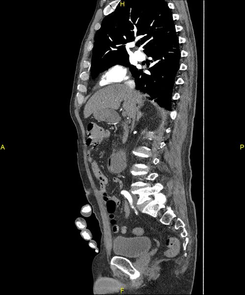 File:Aortoenteric fistula (Radiopaedia 84308-99603 C 144).jpg