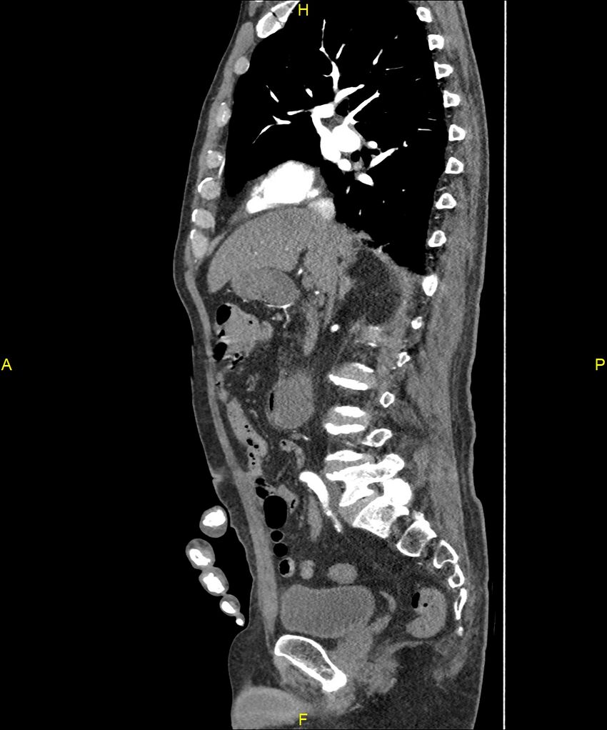 Aortoenteric fistula (Radiopaedia 84308-99603 C 144).jpg