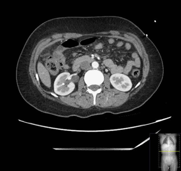 File:Appendicitis (CT angiogram) (Radiopaedia 154713-127660 Axial 103).jpg