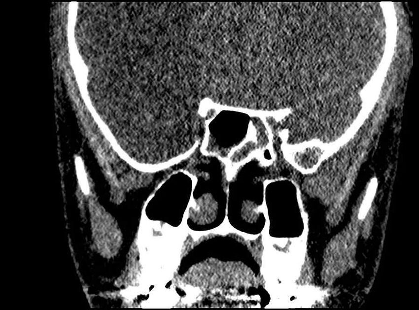 Arachnoid cyst- extremely large (Radiopaedia 68741-78450 Coronal bone window 31).jpg