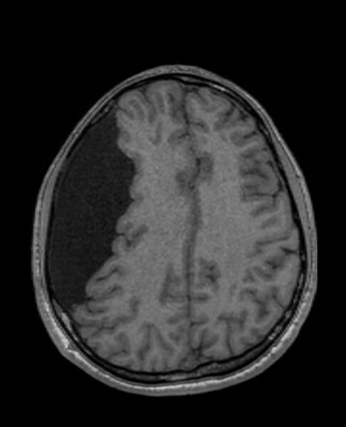 File:Arachnoid cyst- extremely large (Radiopaedia 68741-78451 Axial T1 53).jpg