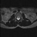Arachnoid cyst - spinal (Radiopaedia 66835-76157 Axial T2 12).jpg