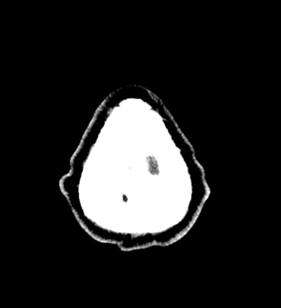 File:Arachnoid cyst of the ambient cistern (Radiopaedia 81301-94986 Axial non-contrast 72).jpg