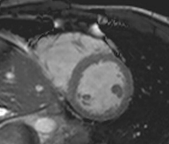 File:Arrhythmogenic right ventricular cardiomyopathy (Radiopaedia 39806-42237 F 1).jpg