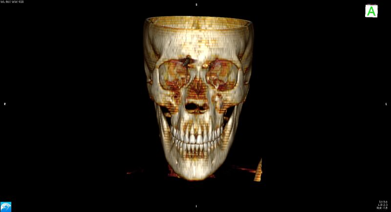 File:Arrow injury to the brain (Radiopaedia 72101-82607 3D bone 3).jpg
