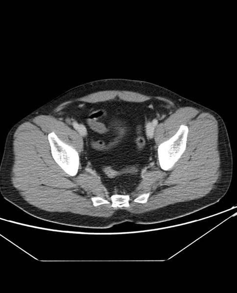 File:Arterial occlusive mesenteric ischemia (Radiopaedia 84641-100054 A 104).jpg