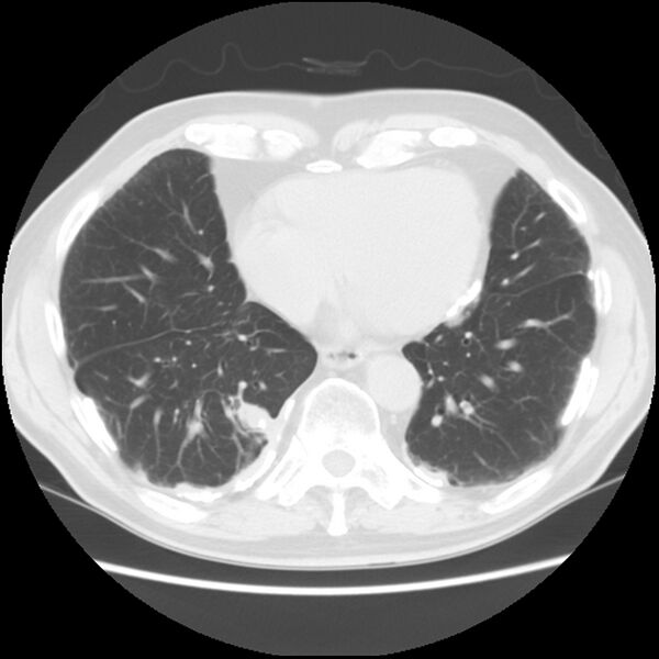 File:Asbestos-related pleural plaques (Radiopaedia 39069-41255 Axial lung window 51).jpg