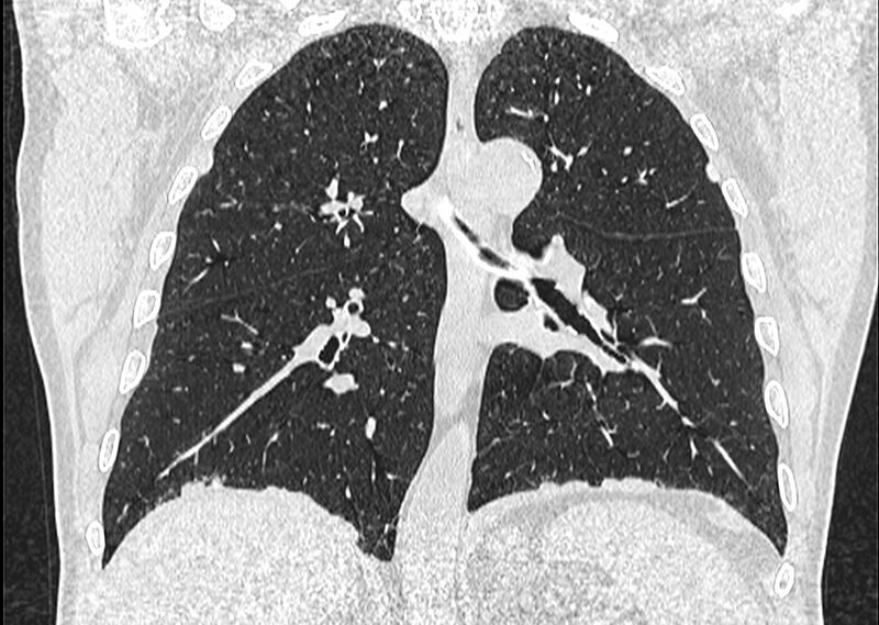 File:Asbestos pleural placques (Radiopaedia 57905-64872 Coronal lung window 173).jpg