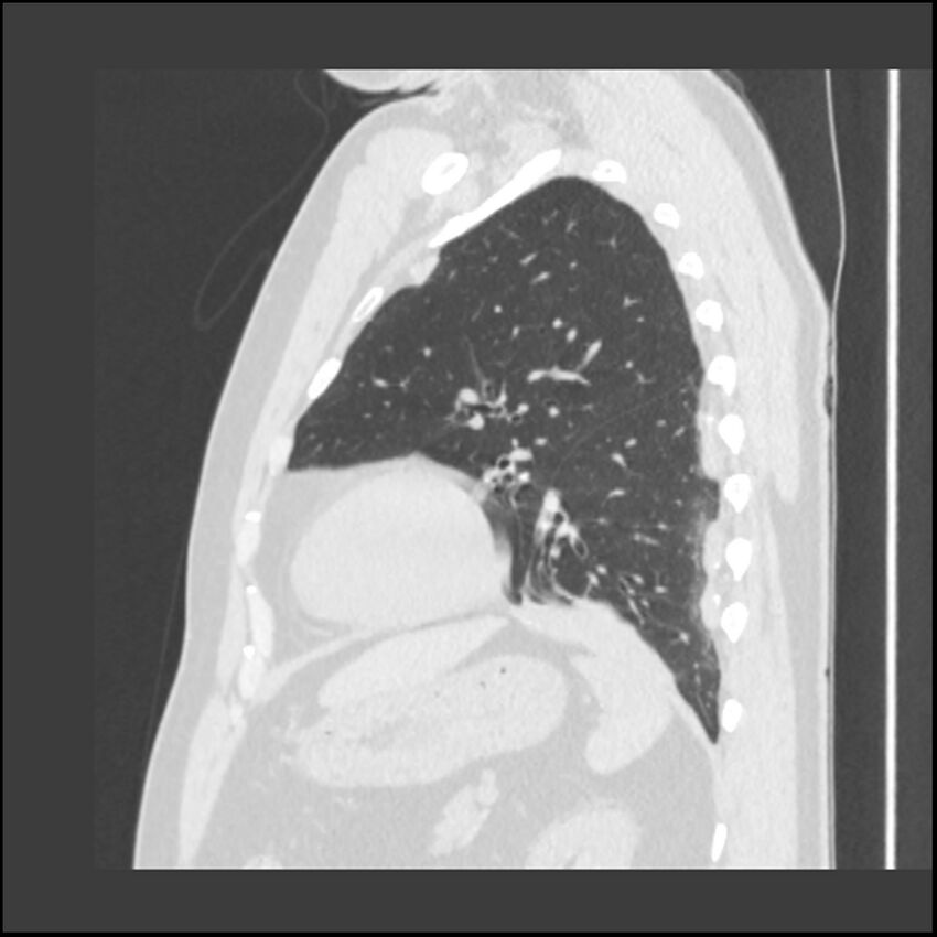 Asbestosis (Radiopaedia 45002-48961 Sagittal lung window 37).jpg