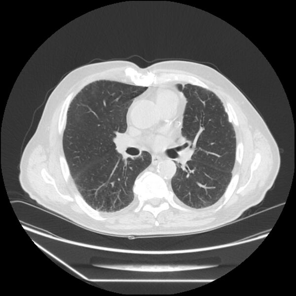 File:Asbestosis complicated by lung cancer (Radiopaedia 45834-50116 Axial lung window 34).jpg