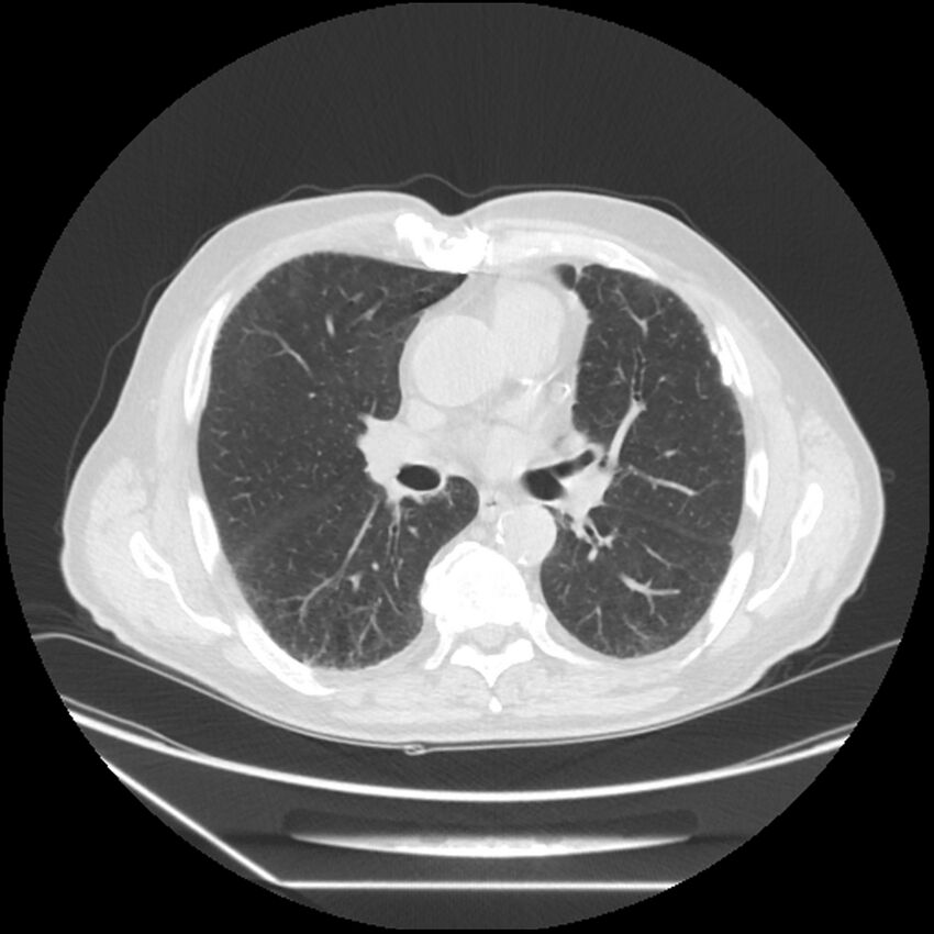 Asbestosis complicated by lung cancer (Radiopaedia 45834-50116 Axial lung window 34).jpg