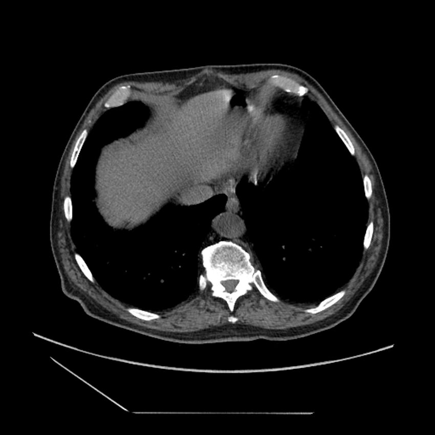 Asbestosis complicated by lung cancer (Radiopaedia 45834-50116 Axial non-contrast 53).jpg