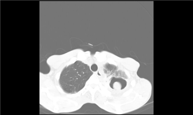 File:Aspergilloma (Radiopaedia 20788-20701 Axial lung window 6).jpg