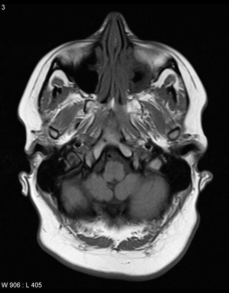 File:Astroblastoma (Radiopaedia 39792-42217 Axial T1 2).jpg