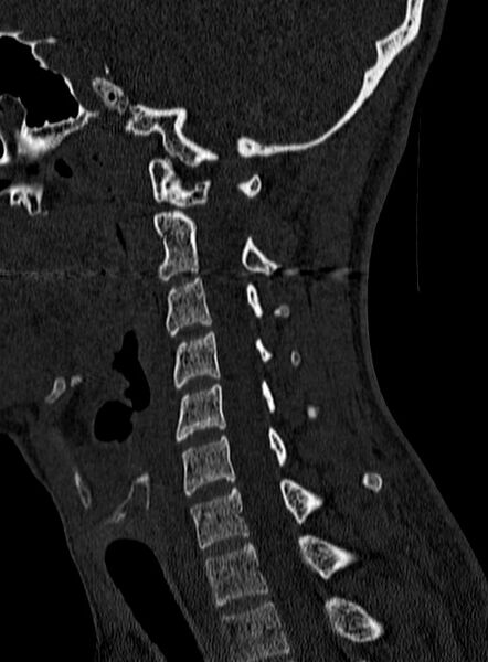 File:Atlantoaxial subluxation (Radiopaedia 44681-48450 Sagittal bone window 95).jpg