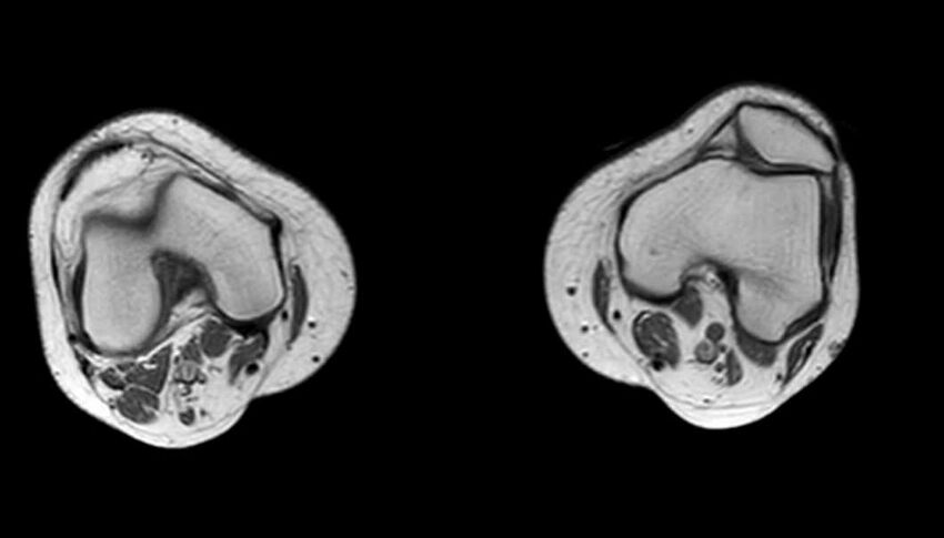 Atypical lipomatous tumor - thigh (Radiopaedia 68975-78734 Axial T1 9).jpg