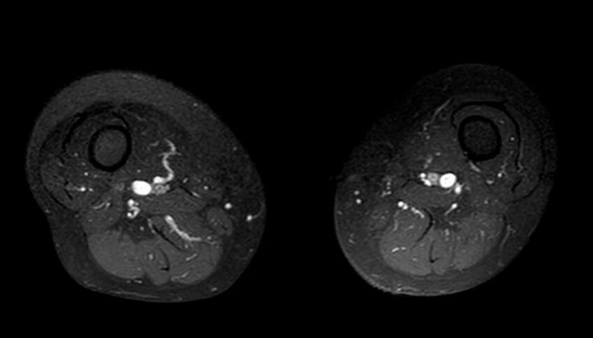 Atypical lipomatous tumor - thigh (Radiopaedia 68975-78734 Axial T1 C+ fat sat 37).jpg