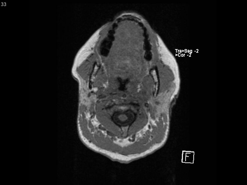 Atypical meningioma - intraosseous (Radiopaedia 64915-74572 Axial T1 33).jpg