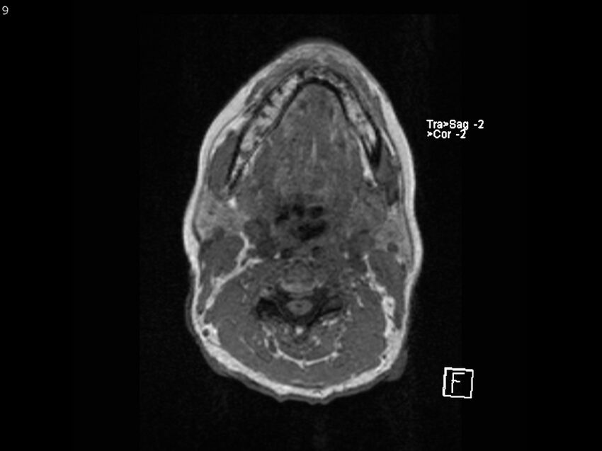 Atypical meningioma - intraosseous (Radiopaedia 64915-74572 Axial T1 9).jpg
