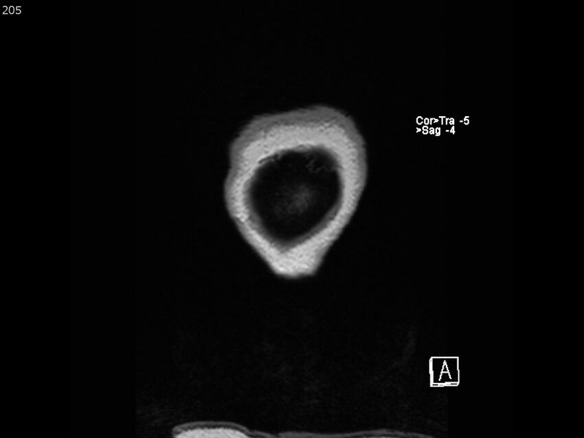 Atypical meningioma - intraosseous (Radiopaedia 64915-74572 Coronal T1 205).jpg