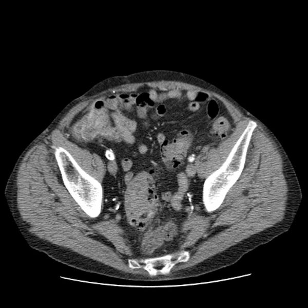 File:Autosomal dominant polycystic kidney disease (Radiopaedia 27851-28094 B 105).jpg