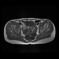 Avascular necrosis of the hip (Radiopaedia 29563-30067 Axial T1 1).jpg