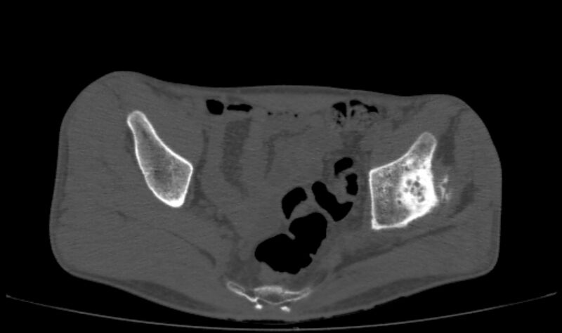 File:Avascular necrosis of the left hip (Radiopaedia 75068-86125 Axial bone window 13).jpg