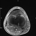 Avulsion fracture of the fibular head (Radiopaedia 74804-85808 Axial PD fat sat 24).jpg