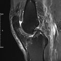Avulsion fracture of the fibular head (Radiopaedia 74804-85808 Sagittal PD fat sat 17).jpg